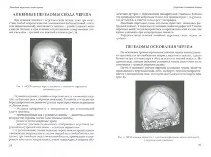 Чем могут сопровождаться переломы костей черепа