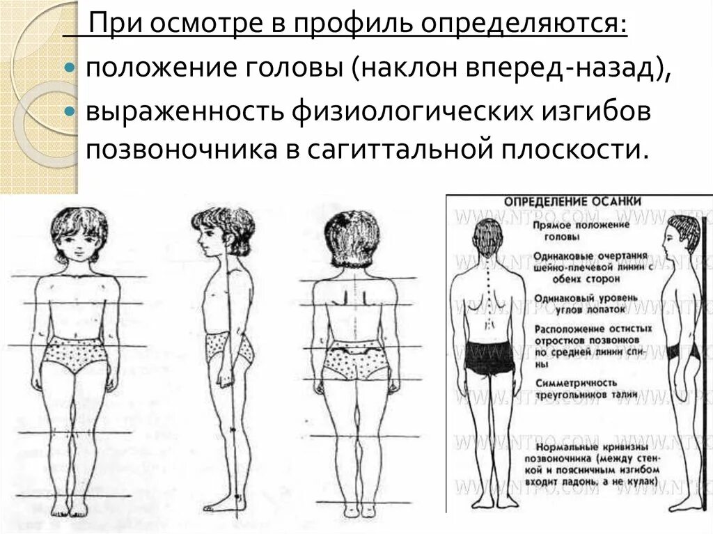 Сагиттальные нарушения осанки. Осанки во фронтальной плоскости. нарушение осанки во фронтальной плоскости. сколиоз во фронтальной плоскости. оценка осанки во фронтальной плоскости.