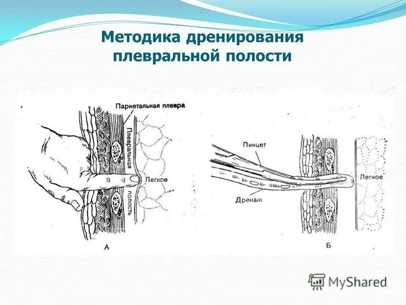 Лечение плевральной полости