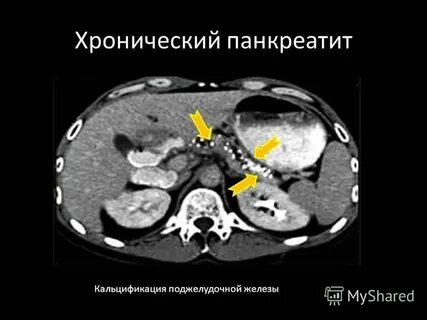 Кт поджелудочной железы