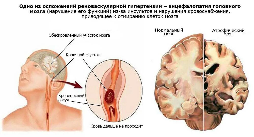 Умеренные атрофические изменения