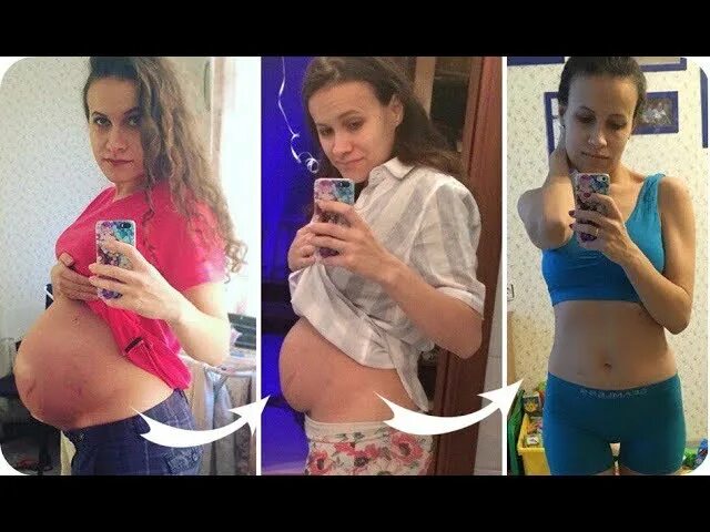 Как похудеть после родов форум. Живот через 2 месяца после родов. живот после родов и похудение. послеродовой живот спустя год после родов. похудение после родов за два месяца.