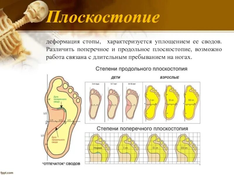 Поперечное плоскостопие отпечаток стопы. Продольное плоскостопие плантография. Продольный свод стопы плоскостопие. Продольное плоскостопие деформация стопы.