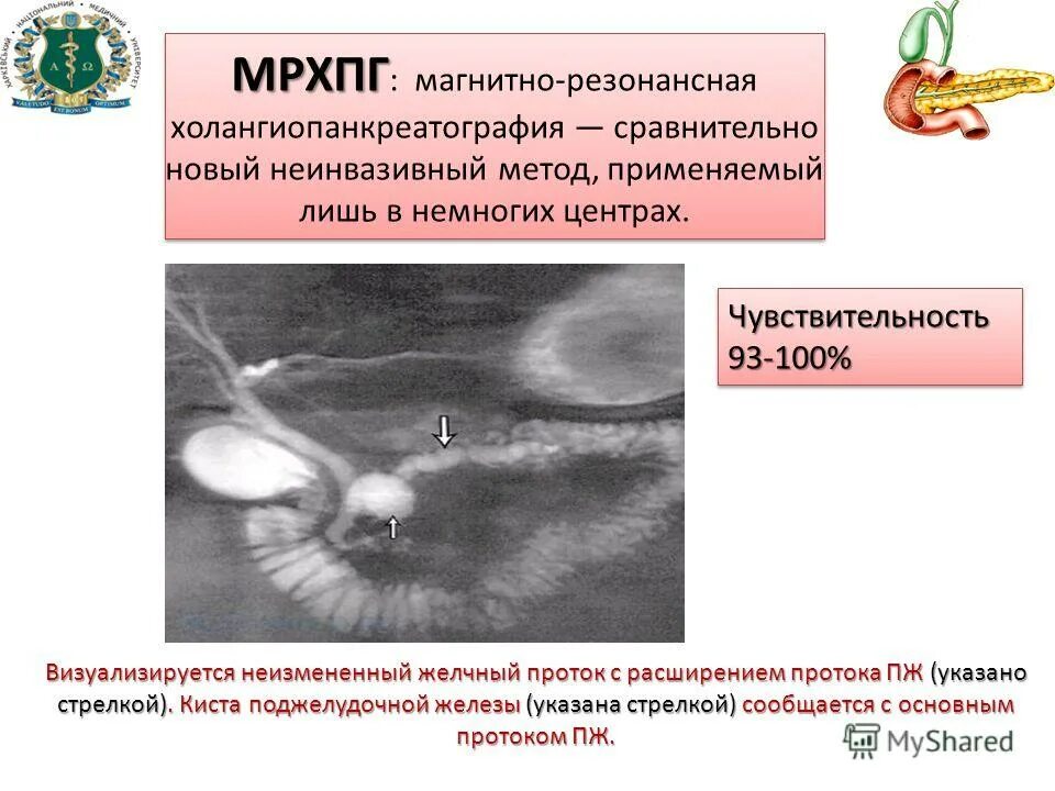 мрхпг поджелудочной железы. заключение магнитно резонансной холангиопанкреатография. мрхпг поджелудочной железы. мрт мрхпг. магнитно-резонансная холангиопанкреатография при жкб.