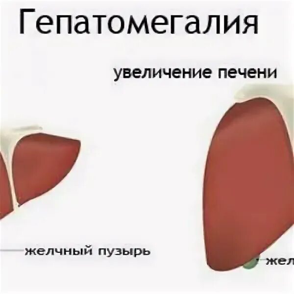 Гепатомегалия код мкб. Гепатомегалия код мкб