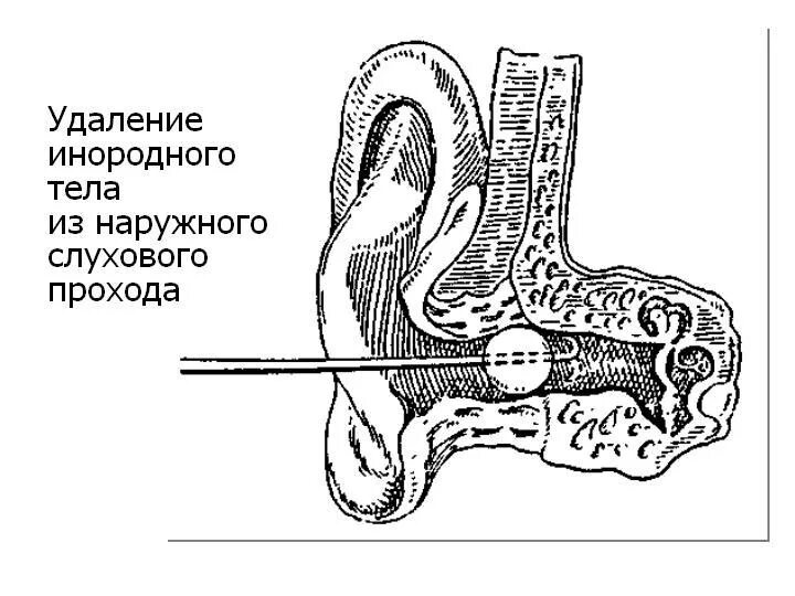 Удаление инородного тела. Инородные тела наружного слухового прохода. инородные тела наружного слухового прохода удаляются. резекция наружного слухового прохода. инородные тела в наружном слуховом проходе.