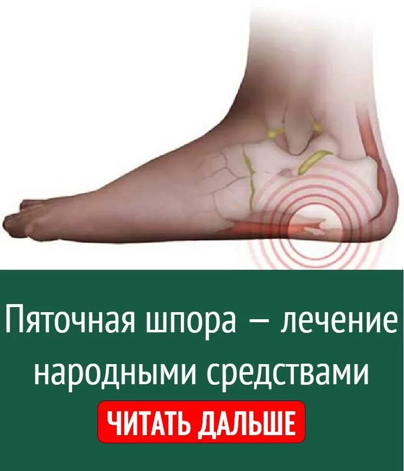 Синдром шпора пяточная. Пяточные шпоры симптомы. шпора на пятке народными средствами.