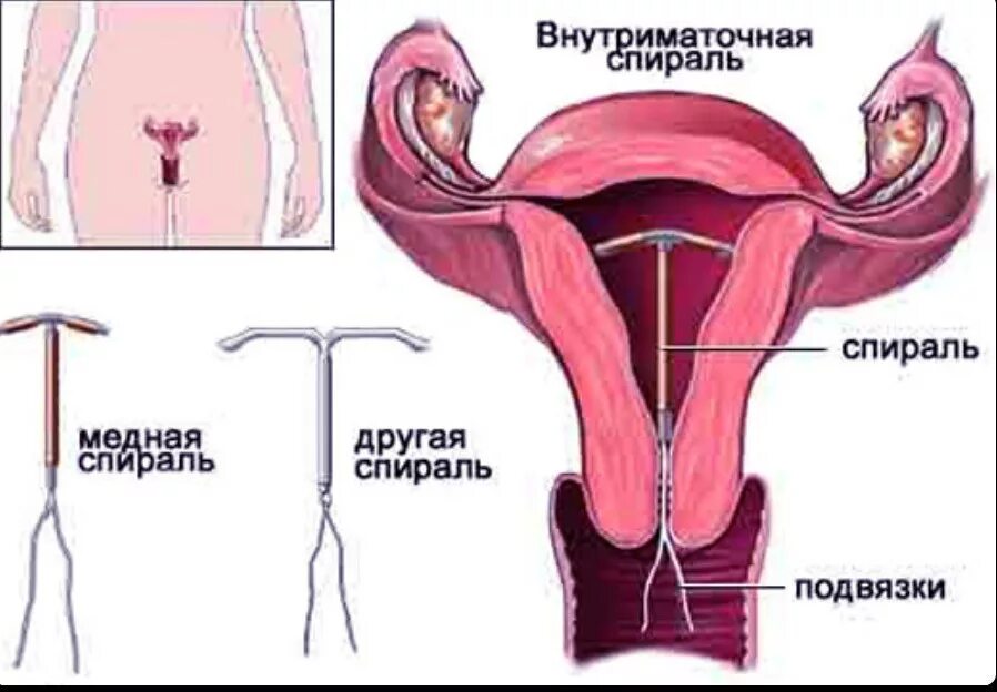 Как работает внутриматочная спираль. Внутриматочный контрацептив спираль. внутриматочная контрацепция (вмк). медьсодержащая внутриматочная спираль. вмс мирена в матке.