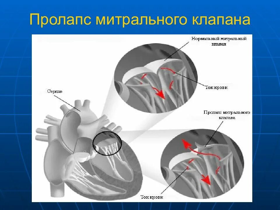 Что такое пролапс митрального клапана. Пролапс митрального клапана (ПМК). Болезнь Барлоу митрального клапана. Пролапс створки митрального клапана. Парашютообразный митральный клапан.