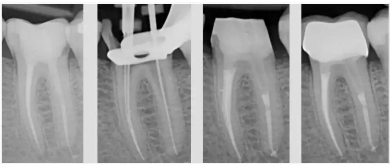 Пломбировка каналов зуба снимок. Выведение пломбировочного материала за Апекс. Запломбированные корневые каналы. Обтурация корневого канала рентген.