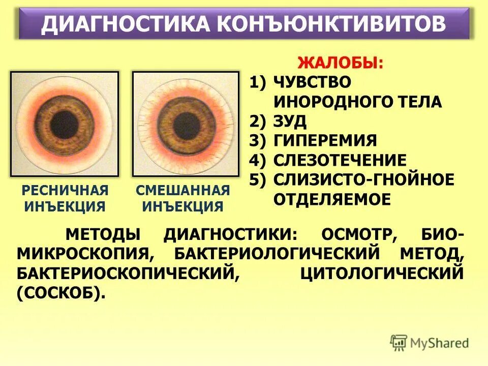 Диагностика конъюнктивита. Бактериальный конъюнктивит диагностика. Дифференциальный диагноз конъюнктивитов. Жалобы при вирусном конъюнктивите.