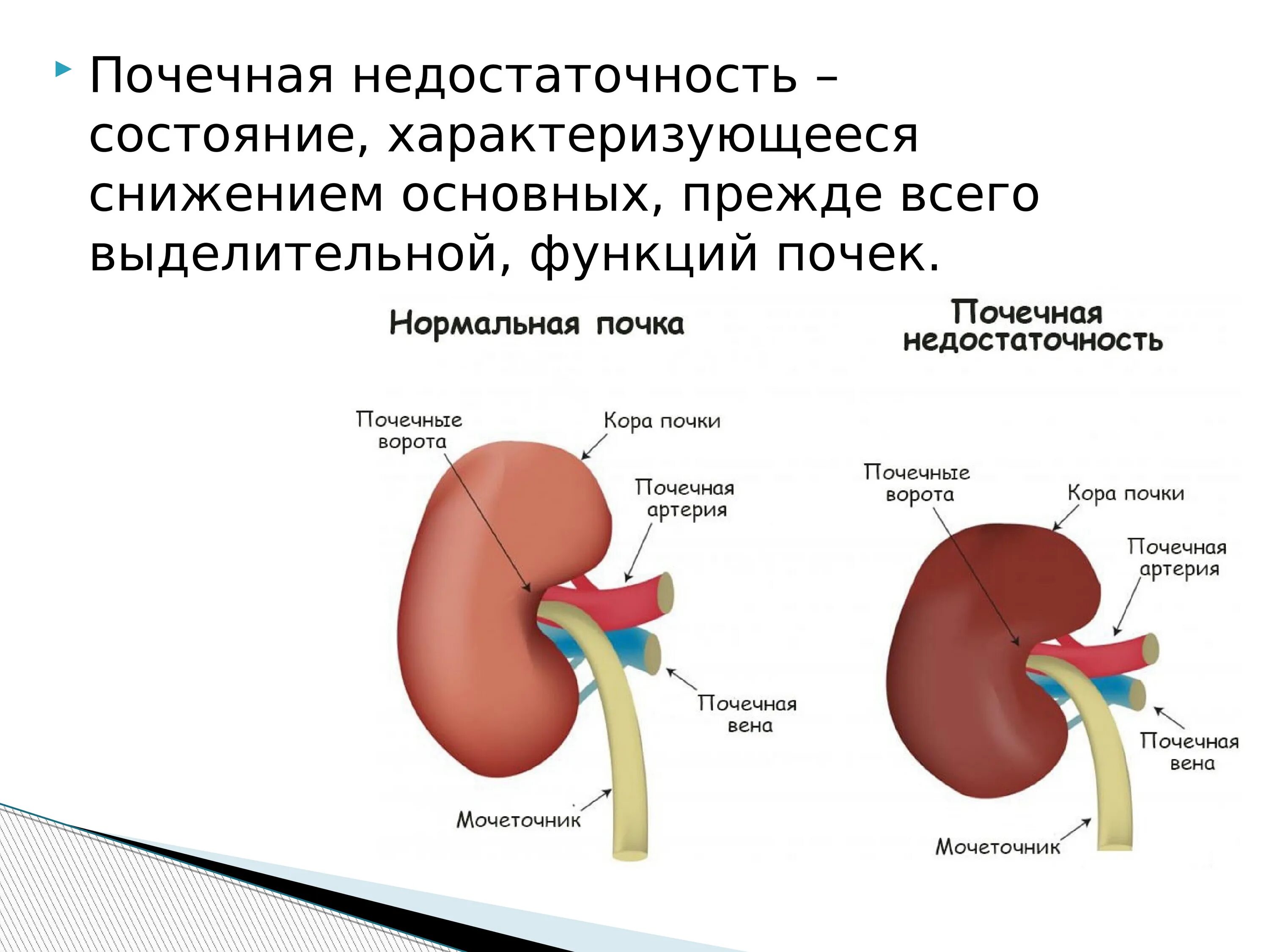 Почки научная статья. Почечная недостаточность уремия. Хроническая почечная недостаточность уремия. Сниженная функция почек. Почечная недостаточность функции.