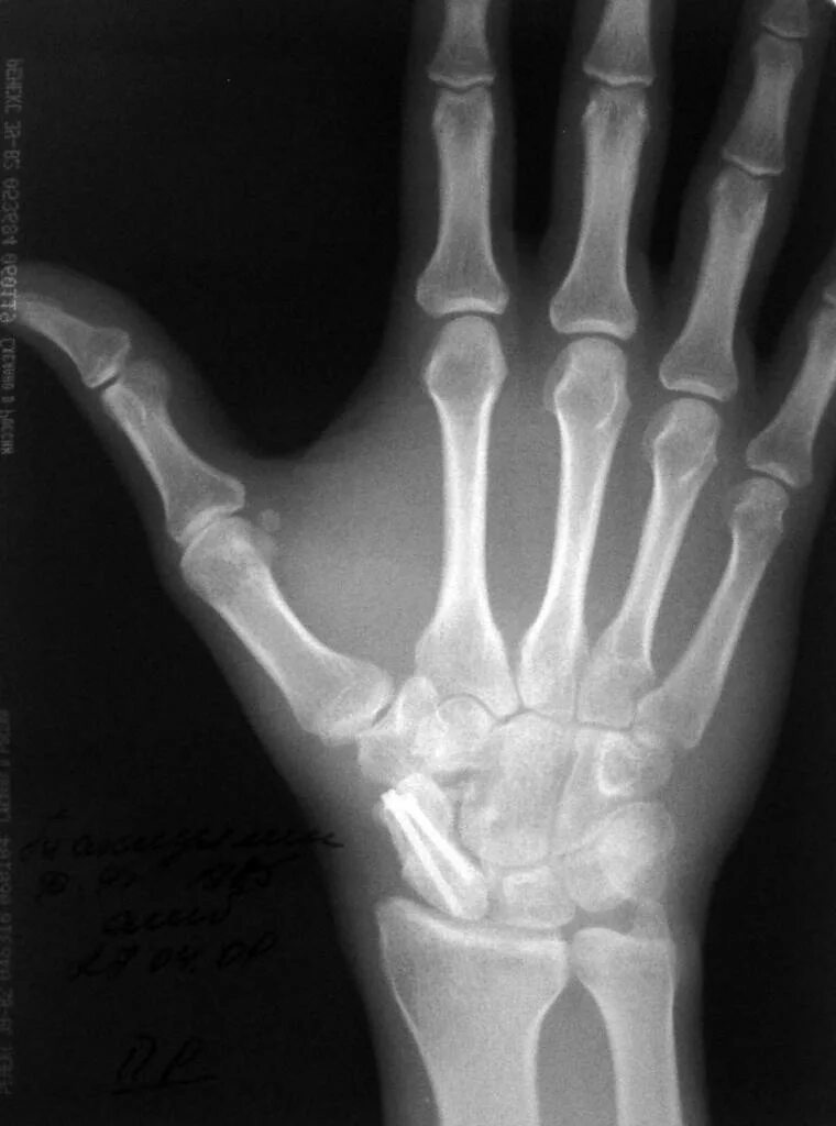 перелом ладьевидной кости кисти рентген. ладьевидная кость кисти рентген. перелом ладьевидной кости запястья. ладьевидная кость руки перелом. перелом ладьевидной кости рентген.