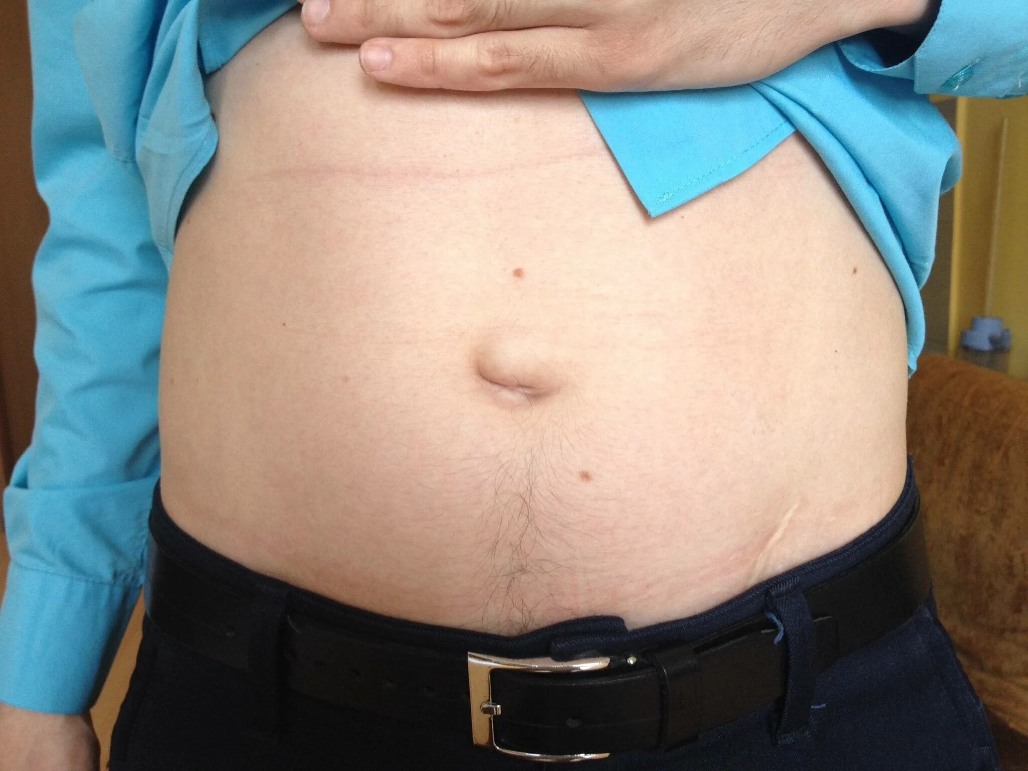 Классификация грыж вентральная грыжа. Внутренние грыжи живота классификация. Классификация пупочных грыж по ehs. Невправимая пупочная грыжа. Грыжа в обл пупка у мужчин.