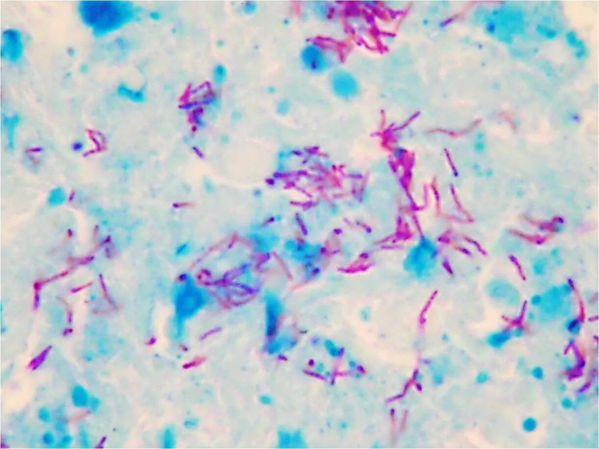 Туберкулез окраска по Цилю-Нильсену. Микроскопия по Цилю Нильсену туберкулез. Микобактерия туберкулеза по Цилю Нильсену. Окраска микобактерий по Цилю-Нильсену.