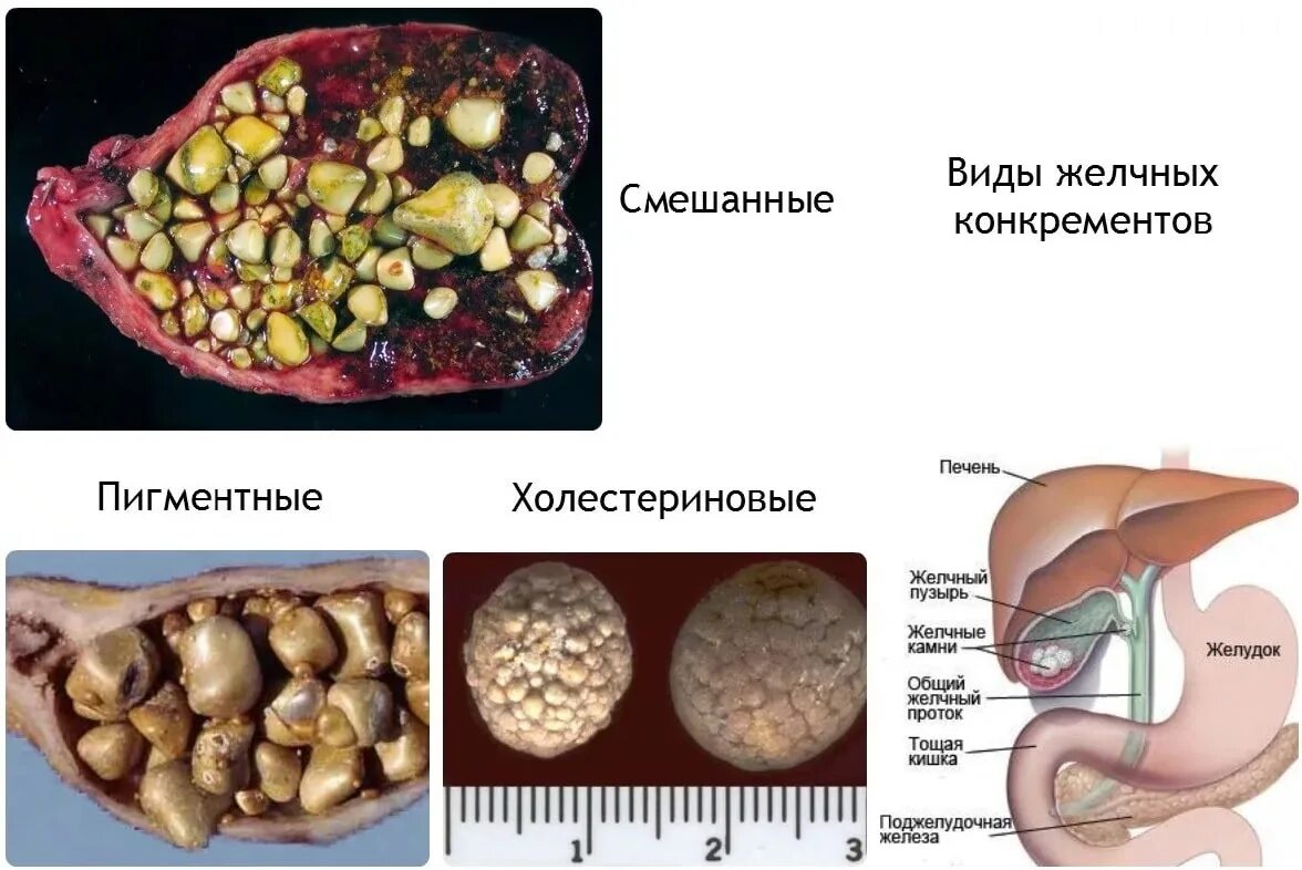 Желчекаменная болезнь у мужчин. Желчнокаменная болезнь (холелитиаз). ЖКБ камни желчного пузыря. Камни желчного пузыря патанатомия. Типы камней при желчнокаменной болезни.