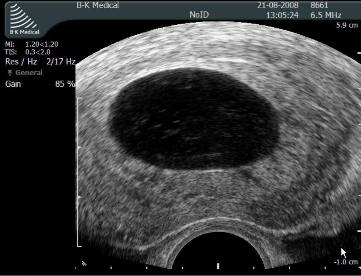 Узи беременности 6-7 недель плодное яйцо. Анэмбриония – пустое плодное яйцо. Неразвивающаяся беременность 7 недель узи. Аноэмбромия беременность. Желточный мешок на узи 6 недель.