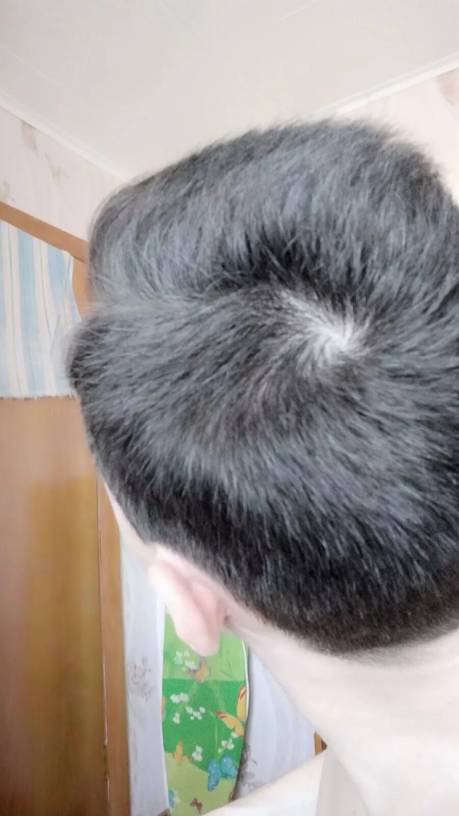 две макушки. две макушки. залысина на макушке. две макушки на голове. две макушки на голове.