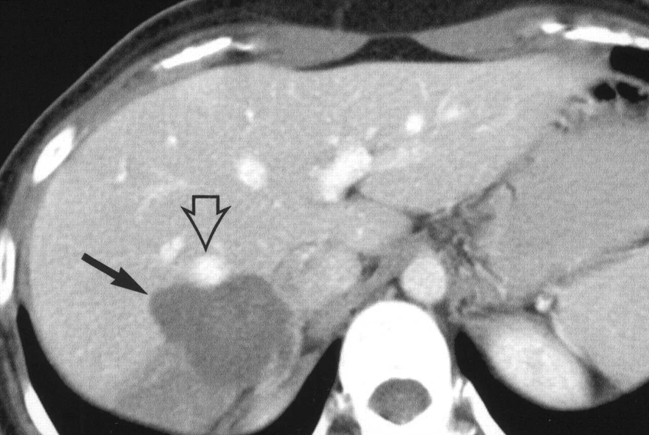 Гемангиома печени причины и лечение. Лакунарная гемангиома печени кт. Кавернозная гемангиома печени кт. Атипичная гемангиома печени на кт. Кавернозная гемангиома печени на УЗИ.