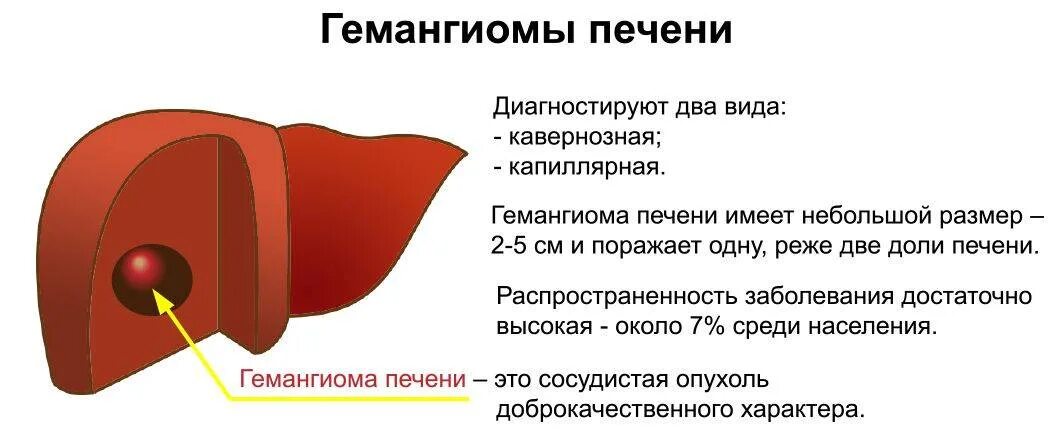 Народное лечение гемангиома печени. Гемангиома печени проявления. как выглядит гемангиома печени. гемангиома правой доли печени у женщин.