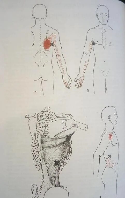 Триггерные точки поясницы. Триггерные точки широчайшей мышцы. Триггерные точки в мышцах спины. КПС триггерные точки. Триггерные точки широчайшей мышцы спины.