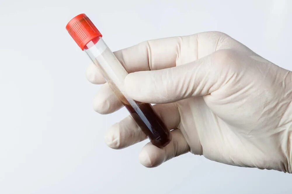 Blood sample и коронавирус ковид 19 и hipospadia и перчатки. Взятие крови на исследование. Blood sample. Колба с кровью. Кровь в пробирке.