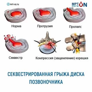 Каудальная миграция грыжи