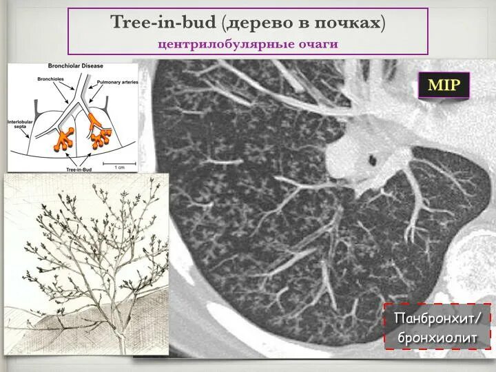 Очаги по типу дерева в почках. Перибронхиальная инфильтрация кт. симптом дерева в почках на кт. дерево в почках на кт. дерево в почках в легких на кт.
