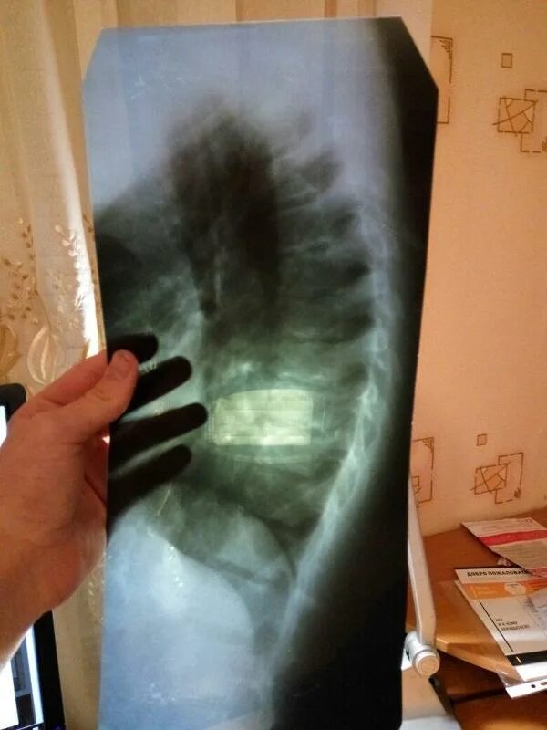 Рентген можно сделать. Рентген. Флюорография позвоночника. Грыжа грудного отдела рентген. Грыжа грудного отдела позвоночника рентген.