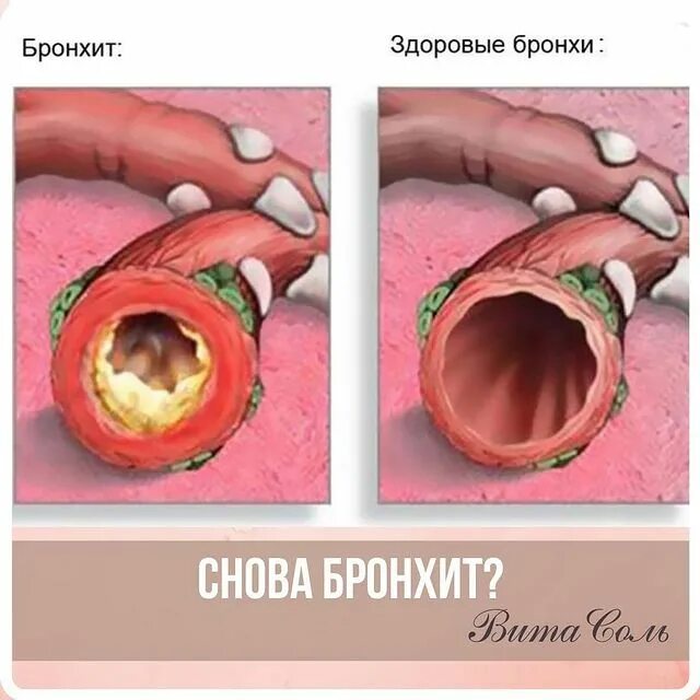 бронхит мелких бронхов