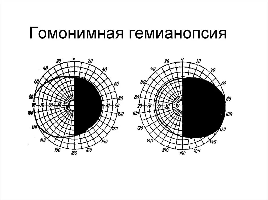 Гомонимная гемианопсия поля зрения. Левосторонняя гомонимная гемианопсия. Правосторонняя гетеронимная гемианопсия. Квадрантная гемианопсия.