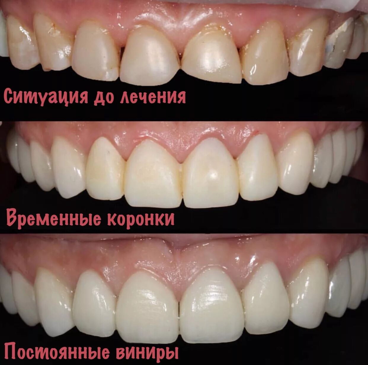 Временные коронки на передние зубы. Пластмассовые коронки на передние зубы. Временные пластиковые коронки.