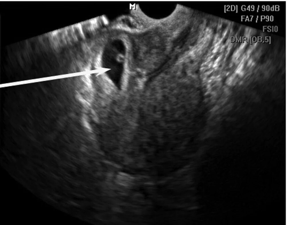 Разрыв плодных. Беременность в рубце на матке. Беременность в рубце на матке УЗИ. Рубец на матке после кесарево на УЗИ. УЗИ матки после кесарева сечения.