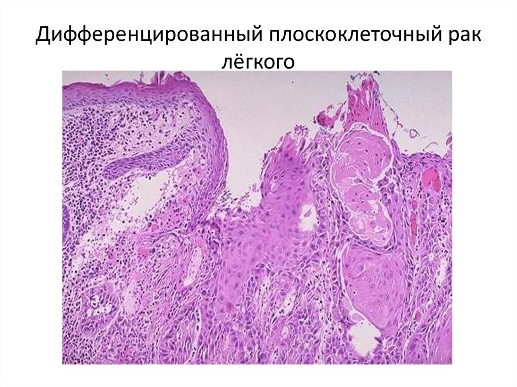 Плоскоклеточными опухолями. Плоскоклкточный раклегкого гистология. Плоскоклеточная аденокарцинома. Плоскоклеточная неороговевающая карцинома легкого.