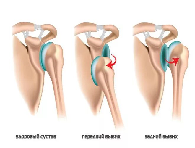 Привычный подвывих плечевого сустава. Вывих плечевого сустава операция. Вывих плечевого сустава травма. Вывих и подвывих плечевого сустава. Разрыв плечевого сустава симптомы