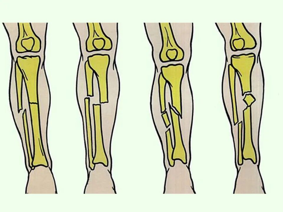 Виды переломов нижних конечностей. Перелом диафиза костей голени. Перелом большеберцовой кости. Перелом большеберцовой кости гипс.