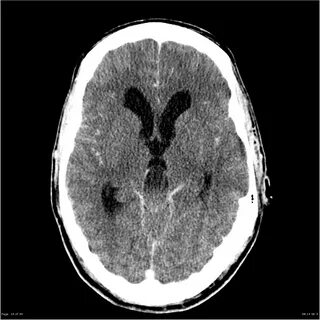 Pm ct