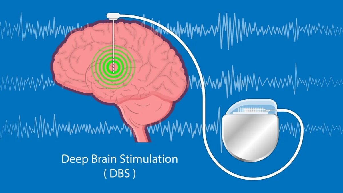 Deep brain. Глубокая стимуляция мозга при болезни Паркинсона. Глубокая стимуляция мозга DBS. Электроды в головной мозг. Электрод для глубокой стимуляции мозга.