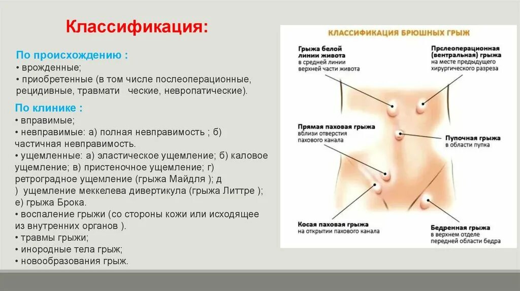 Невправимая грыжа живота. Пупочная грыжа классификация. Рецидивная грыжа белой линии живота. Паховая, пупочная грыжи и грыжа белой линии живота. Послеоперационная грыжа мкб 10