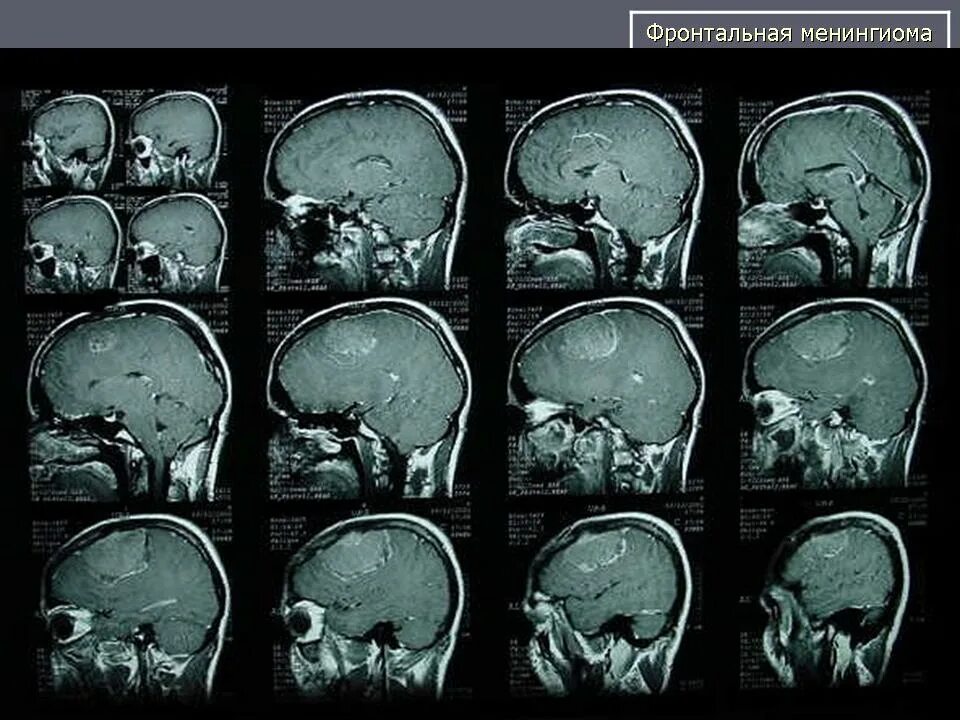 Менингиома рентген черепа. Ольфакторная менингиома. Менингиома кости черепа. Менингиома основания черепа. После операции менингиомы головного мозга