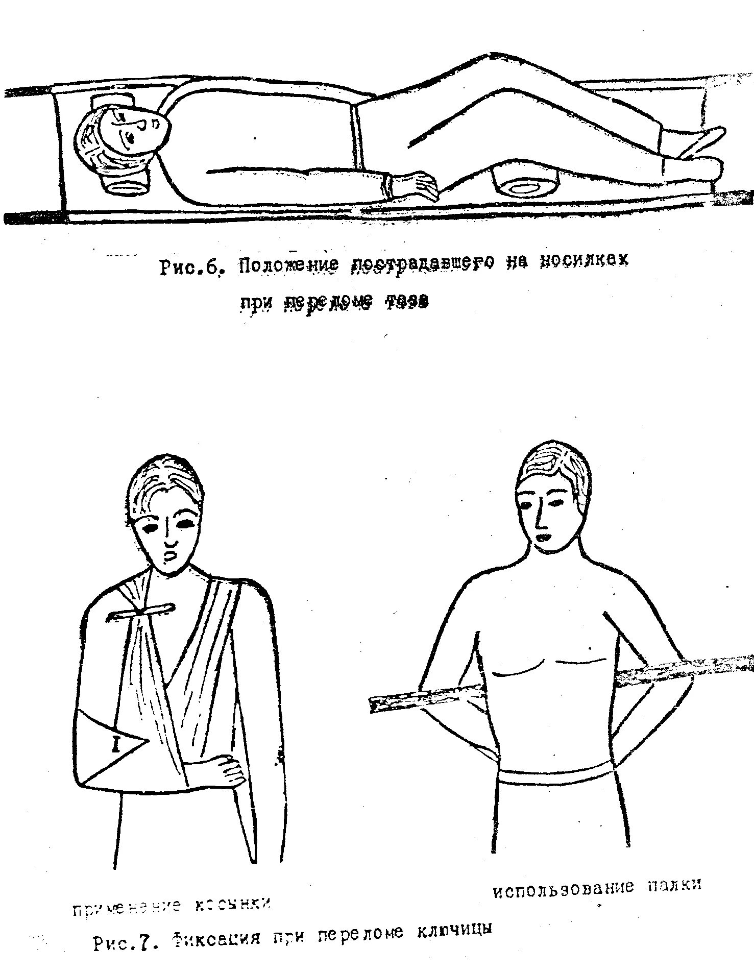 При переломе ключицы оказывают первую помощь. Транспортировка пострадавшего при переломе ключицы. транспортировка и иммобилизация при переломе ключицы. как транспортировать пострадавшего при переломе ключицы?. транспортировкапри переломе клюяицы.