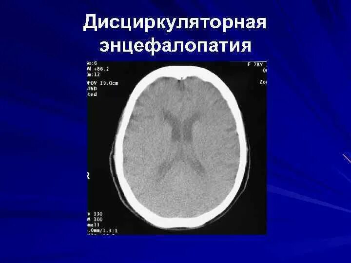 Дисциркуляторная энцефалопатия головного мозга на кт. Дисциркуляторная энцефалопатия мрт. Дисциркуляторная энцефалопатия на кт на кт. Кт картина дисциркуляторной энцефалопатии. Дисциркуляторные дистрофические изменения