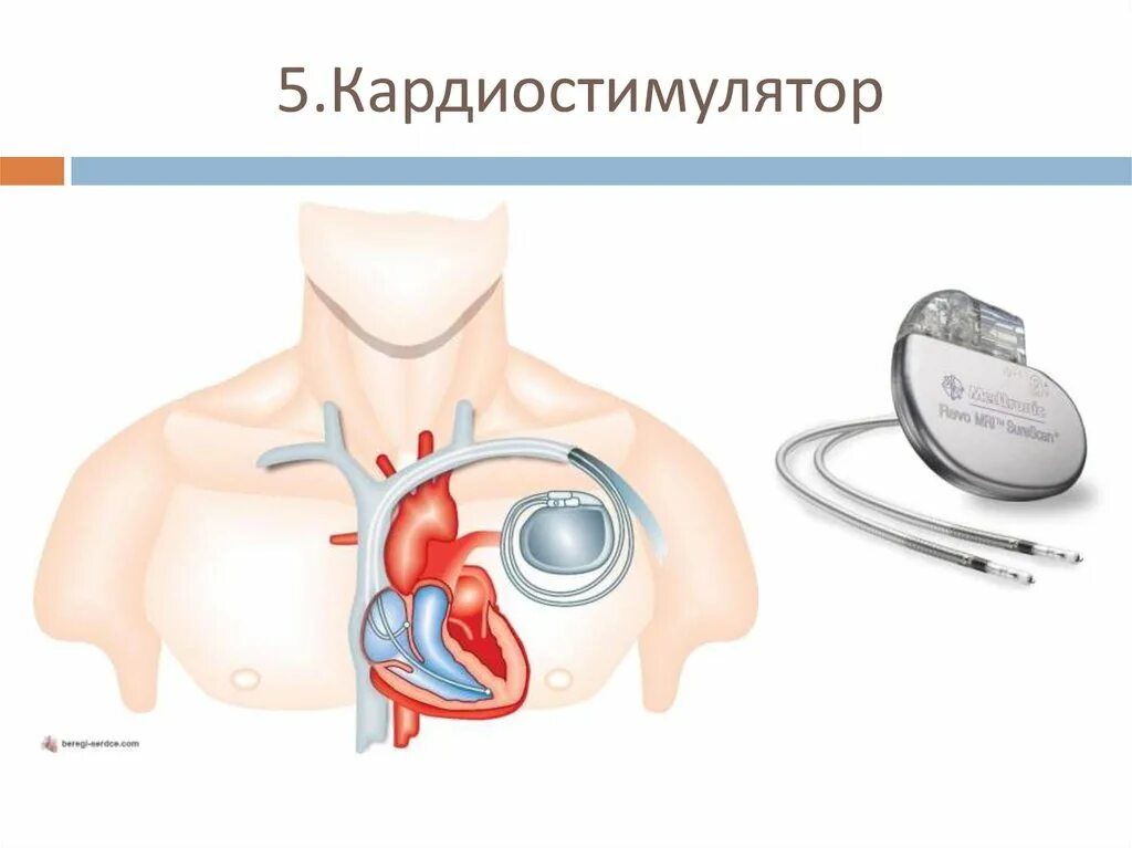 Если стоит кардиостимулятор можно. Двухкамерный кардиостимулятор. Наружный кардиостимулятор. Имплантация электрокардиостимулятора.