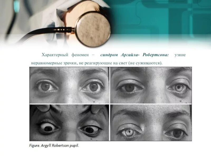 Синдром арджила робертсона. Синдром аржира робертсона. Синдром арджил робертсона. Симптом аргайль-робертсона возникает при. Признаки синдрома аргайла робертсона.