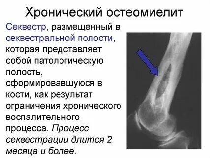 Клинические рекомендации патологический перелом