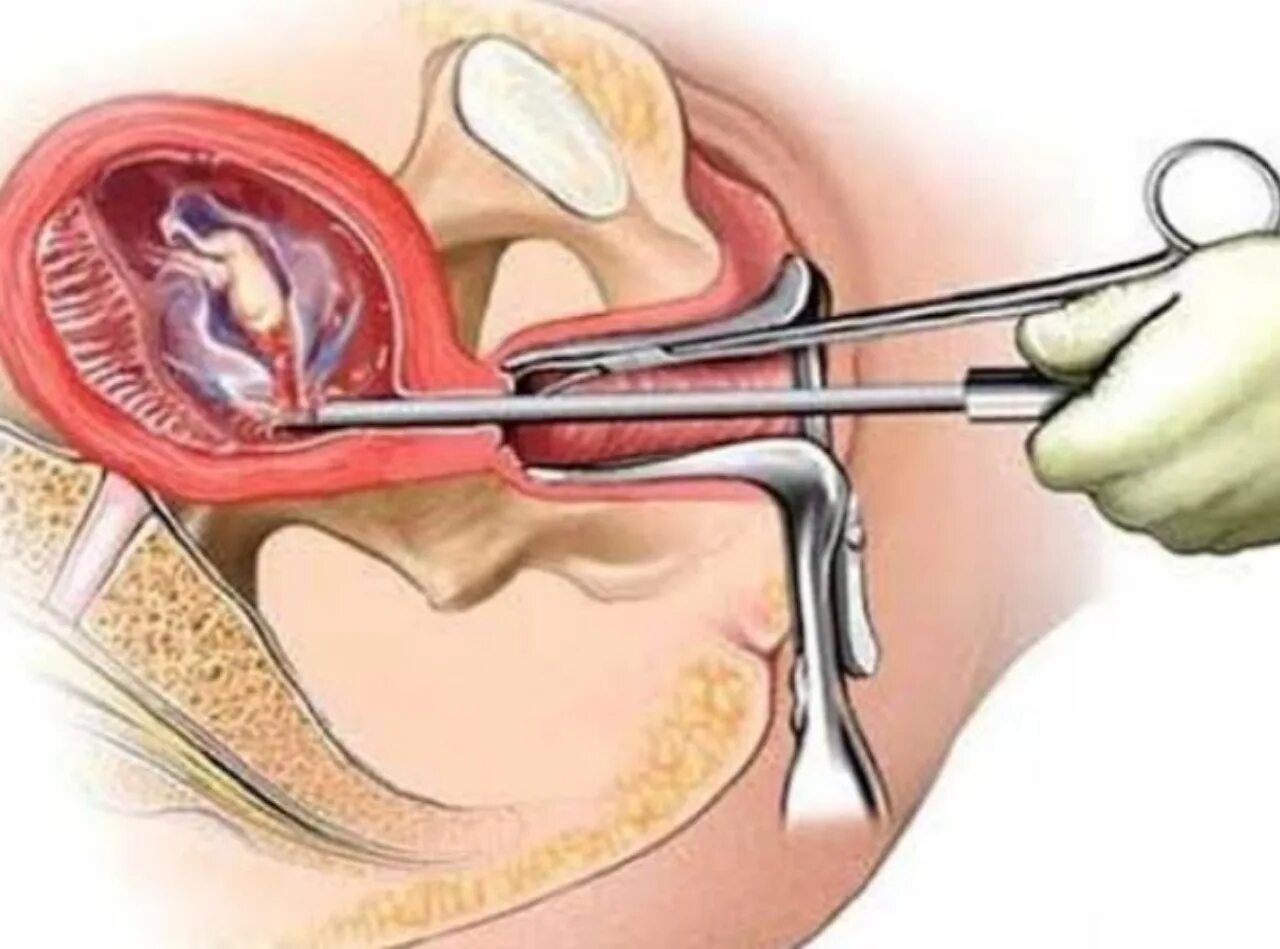 Как называется выскабливание. Вакуум аспирация аборт. Выскабливание полости матки. После вакуум аспирации. Инструментальный аборт.