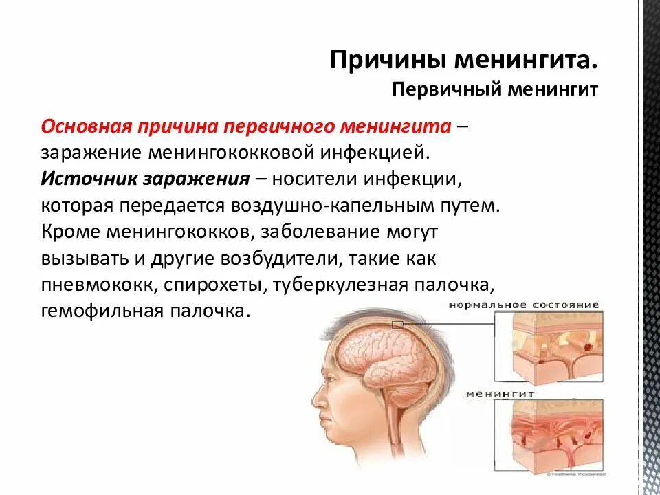 Причины развития менингита. Презентация на тему менингит. Что такое менингит симптомы