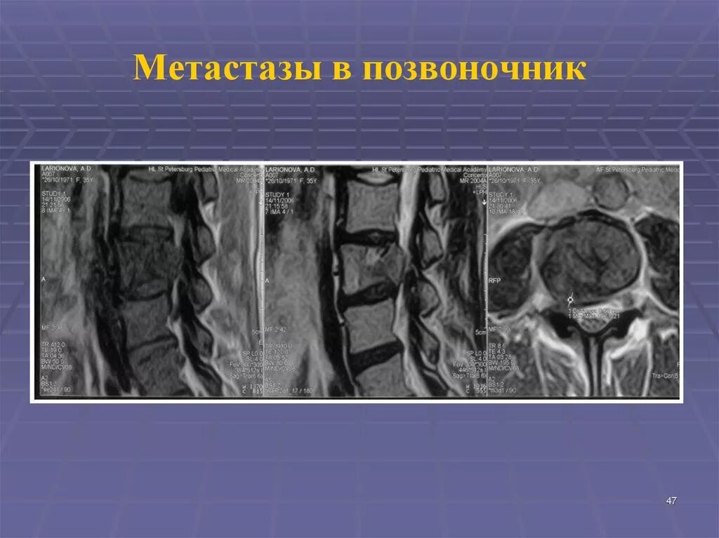Метастазы по всему скелету. Литические метастазы в позвоночнике кт. метастаз в теле позвонка на мрт. метастазы в позвоночнике на мрт.