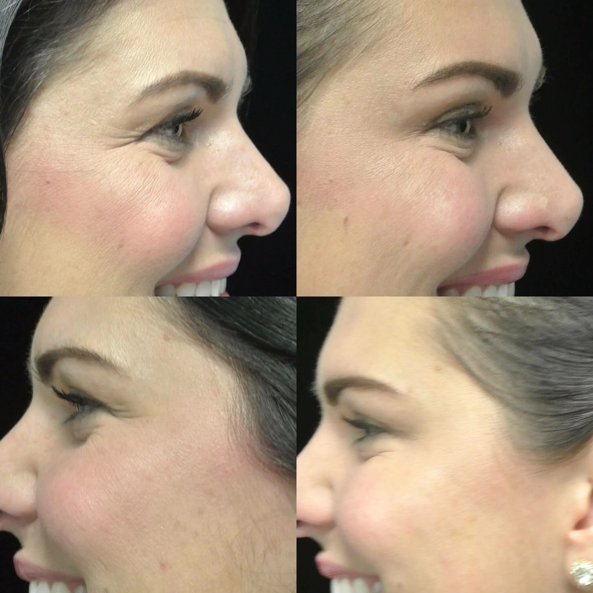 Nose Job To Fix Bulbous Nose Rhinoplasty Cost Pics Reviews QA Rhinoplasty cost, 