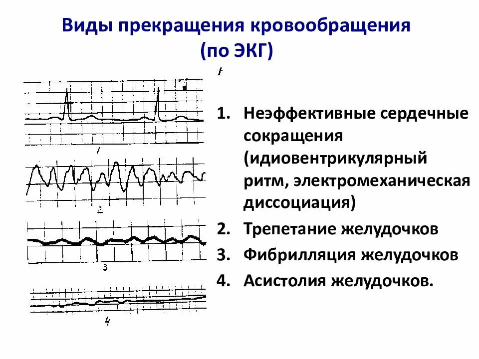 Асистолия сердца это. Асистолия желудочков на ЭКГ. Идиовентрикулярный ритм на ЭКГ. Асистолия сердца на ЭКГ. Изменения на ЭКГ при асистолии.